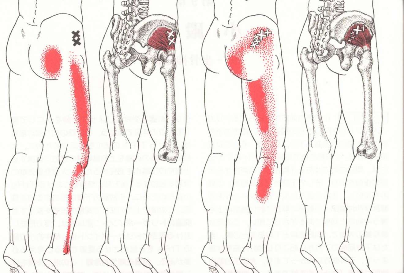 AKS療法 腰下肢痛への治療戦略と梨状筋の筋細胞リリース』 山内義弘 